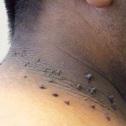 SKIN TAG - त्वचेवरील मांस वाढणे